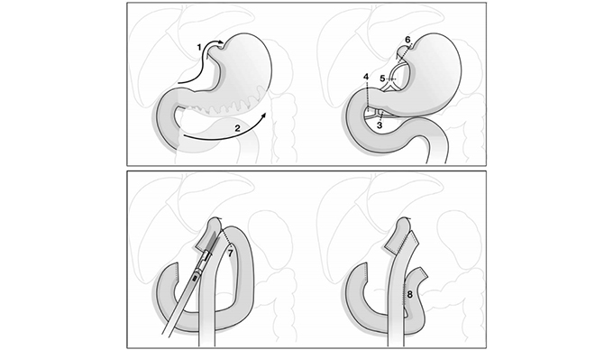 Gastrectomia Total Laparoscópica Minimamente Invasiva com Oesofagojejunostomia Linear Grampeada-Experiência dos Primeiros Trinta Procedimentos